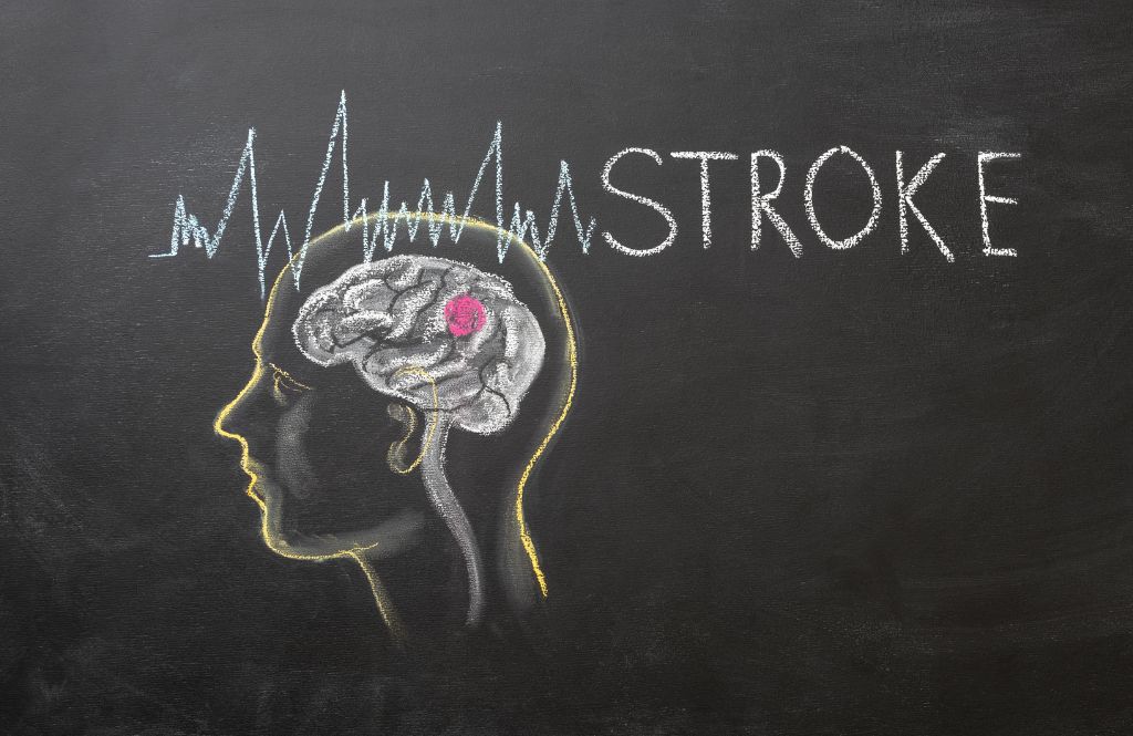 Stroke Management
