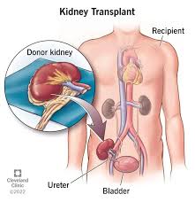 Kidney Transplant
